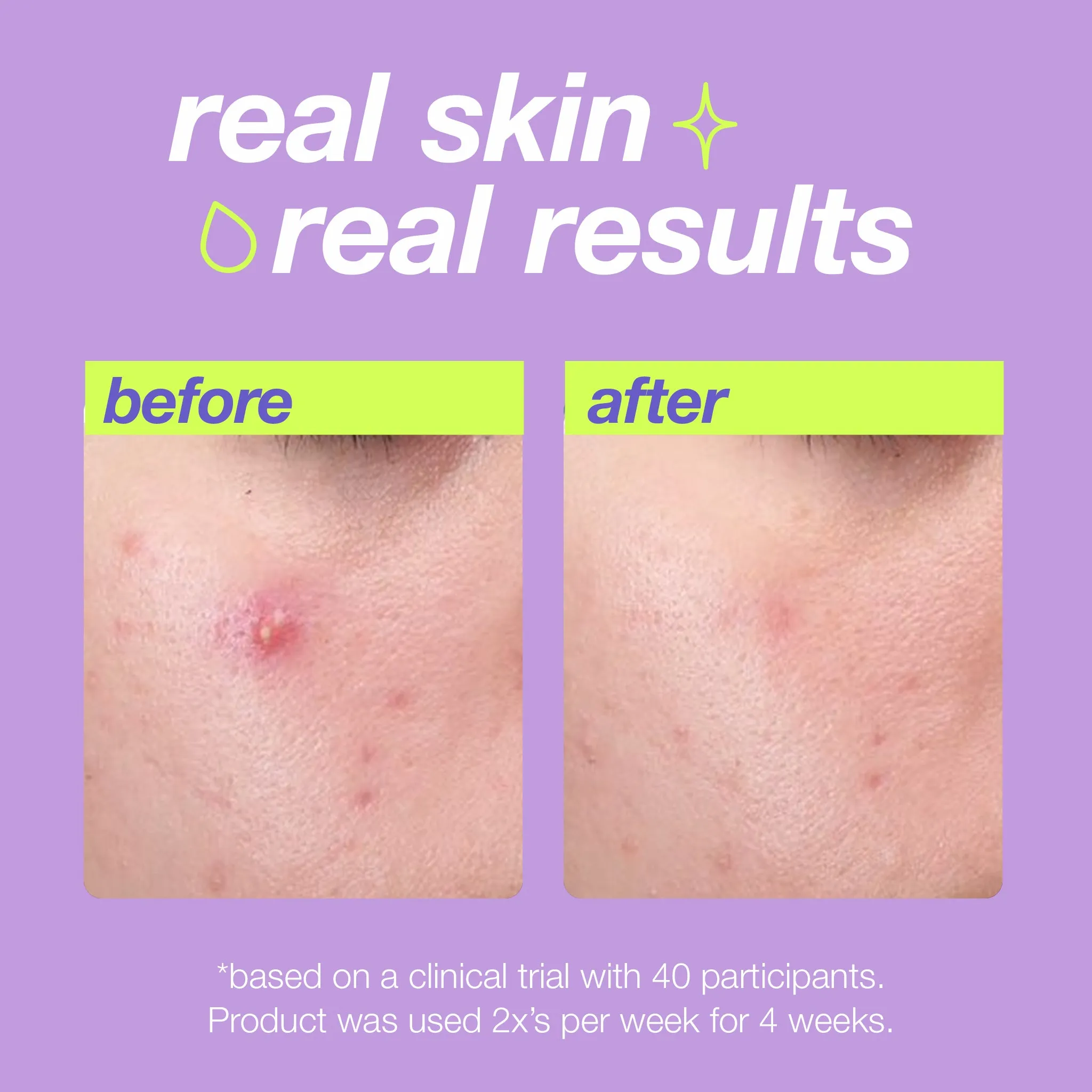 Dermalogica Breakout Clearing Liquid Peel